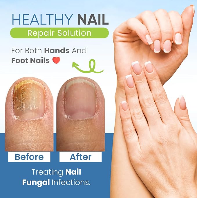 Nail Fungus Laser - Use for Hands & Feet - Image 4